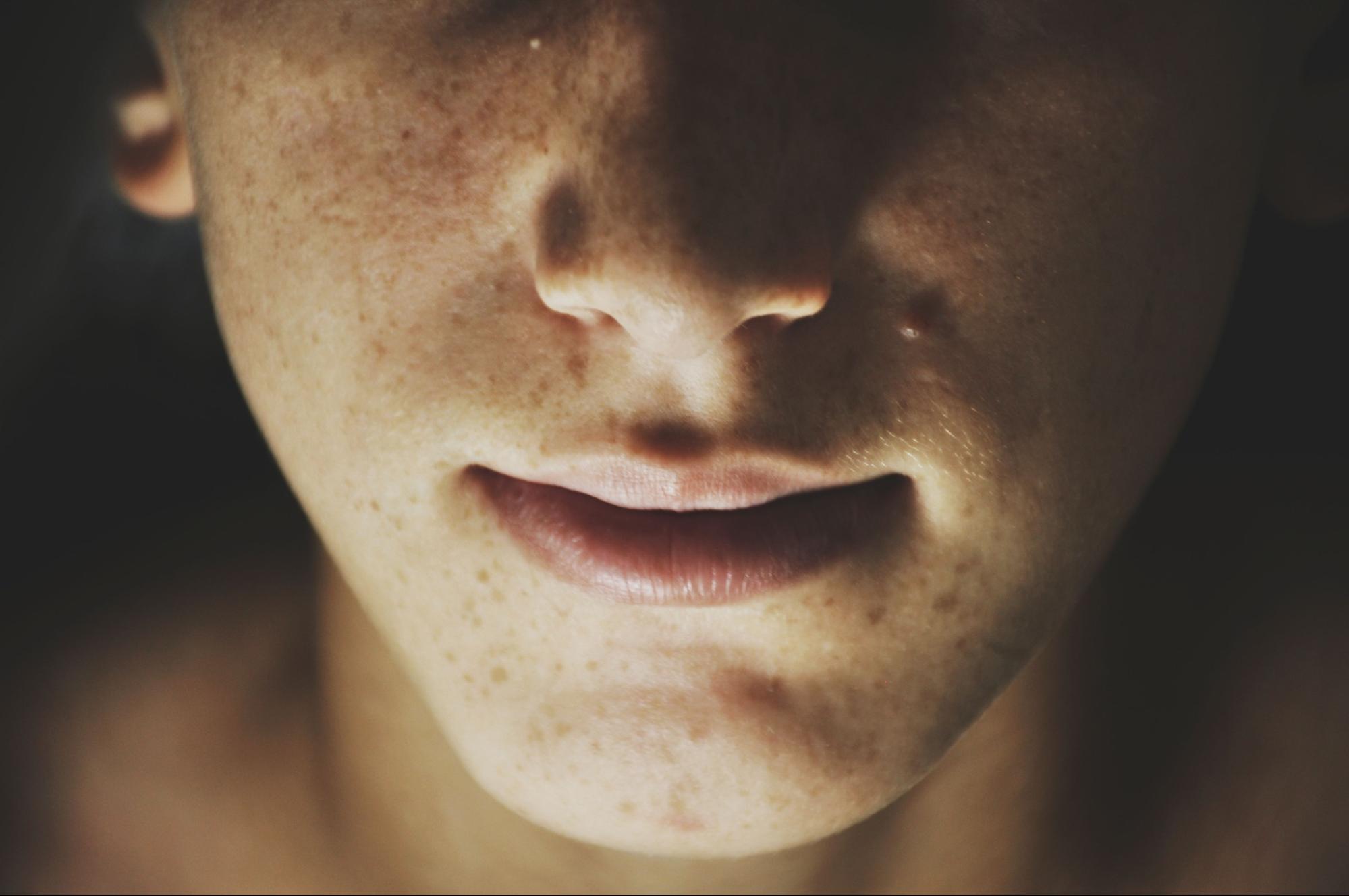 acne scars